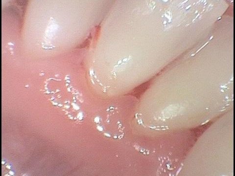 Čistý povrch zubů po odstranění zubního kamene a zdravá dáseň
