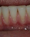 Obnažené krčky na předních zubech, vpravo stav po chirurgickém krytí krčků