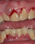 Masivní nánosy povlaku,zubního kamene a krvácení dásní, vpravo po profesionální dentální hygieně 