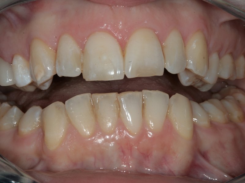 Odstín zubů před domácím bělením, vpravo po bělení