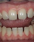 Odstín zubů před domácím bělením a vpravo po bělení