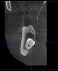 Zobrazení uložení dolní osmičky pomocí CT scanu