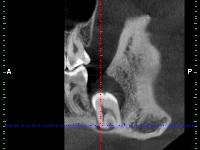 Zobrazení uložení dolní osmičky pomocí CT scanu 