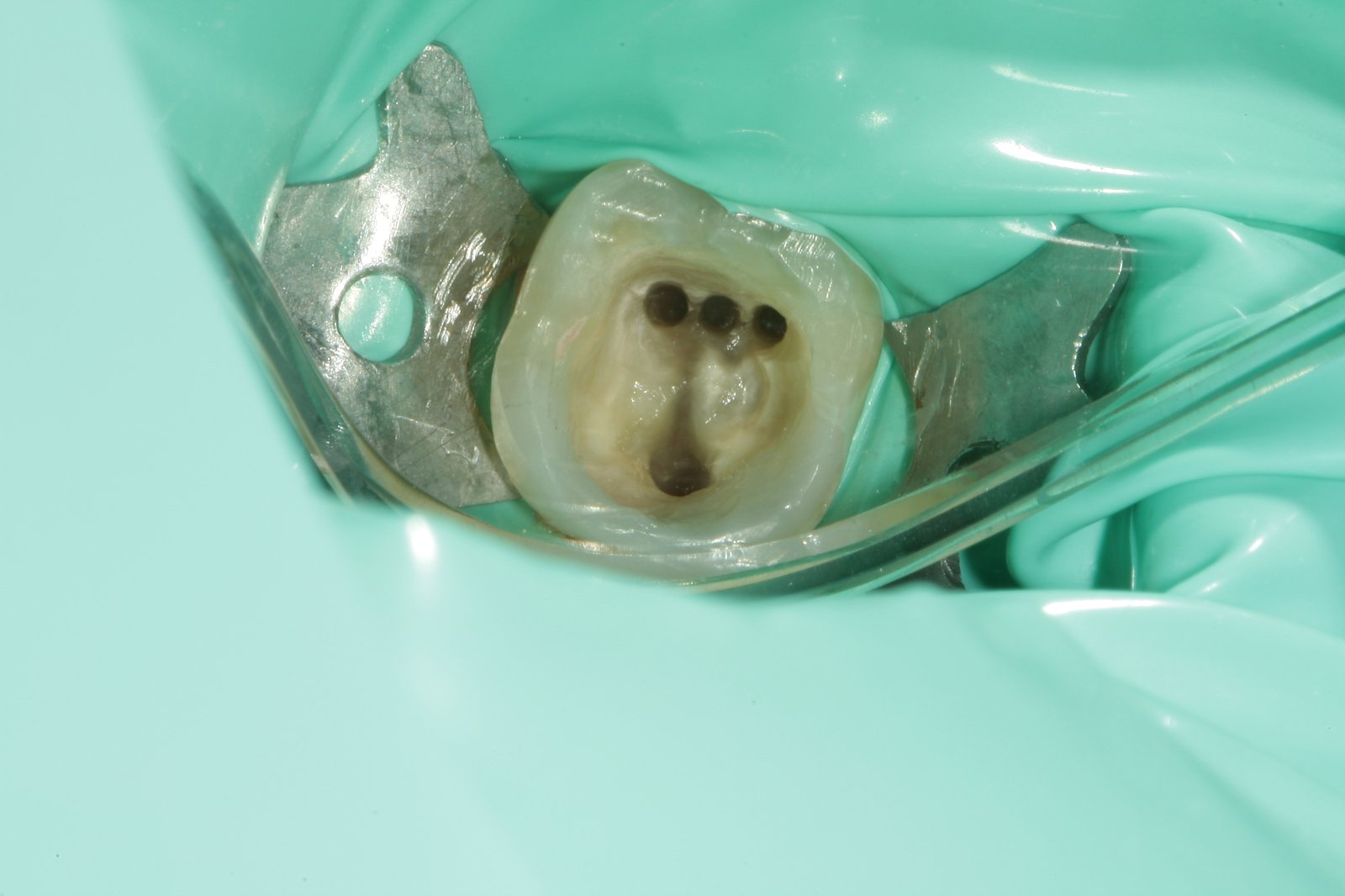 Endodoncie - ošetření kořenových kanálků | Dentální klinika Jan ...