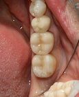 Keramické overlaye (vlevo) na šestce a sedmičce a celokeramická korunka na pětce z důvodu rozsáhlé kazivé destrukce zubů (vpravo)