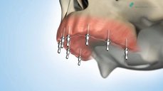 Implantologické fixní řešení bezzubé horní čelisti