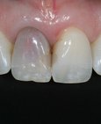 Vnitřní bělení zubu - před a vpravo po vnitřním bělení