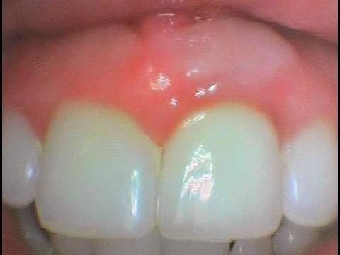 Úprava dásně