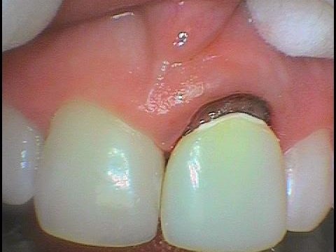 Úprava délky korunky a okolní dásně