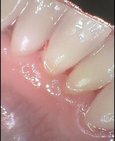 Čistý povrch zubů po odstranění zubního kamene a zdravá dáseň