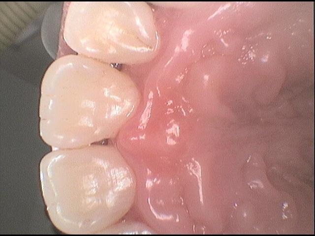 Čistý povrch zubů po odstranění pigmentací pomocí air-flow