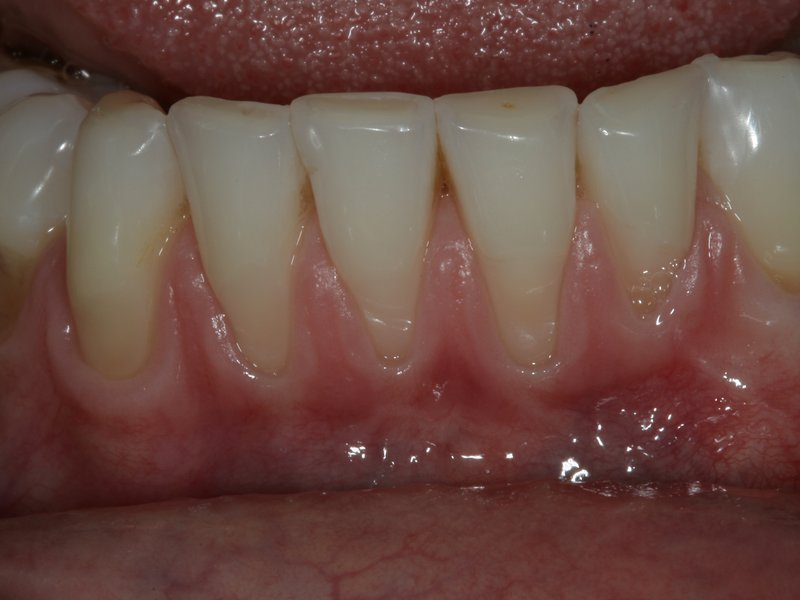 Obnažené krčky na předních zubech, vpravo stav po chirurgickém krytí krčků