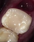 Dostavba zubu po ošetření kořenových kanálků z kompozitní pryskyřice