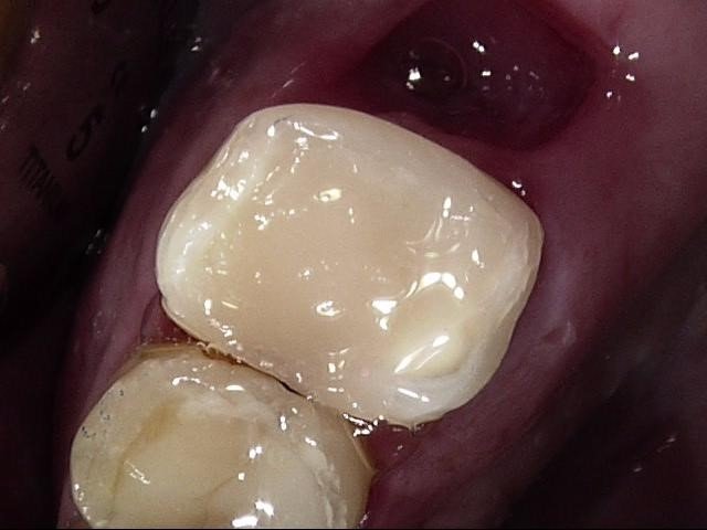 Dostavba zubu po ošetření kořenových kanálků z kompozitní pryskyřice