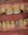 Kazem destruovaný chrup, nevyhovující barva a tvar zubů a vpravo komplexní estetická rekonstrukce celokeramickými korunkami
