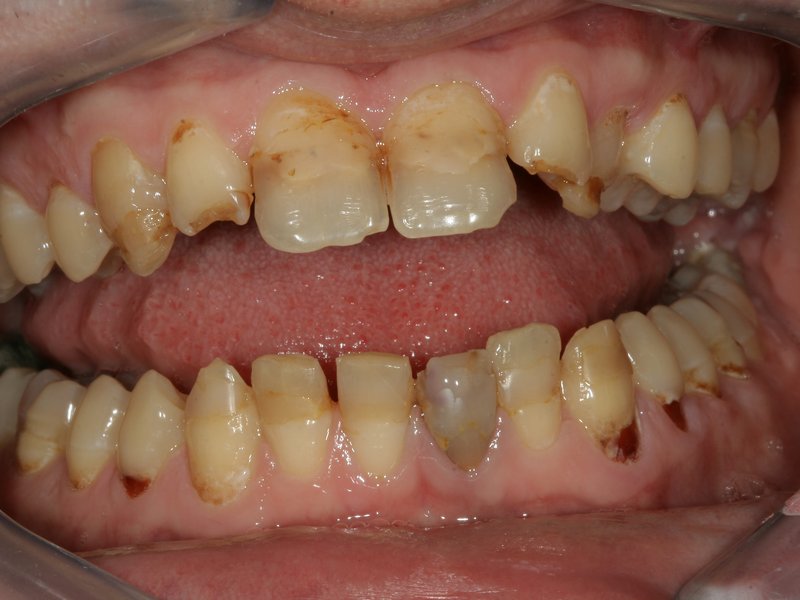 Kazem destruovaný chrup, nevyhovující barva a tvar zubů a vpravo komplexní estetická rekonstrukce celokeramickými korunkami
