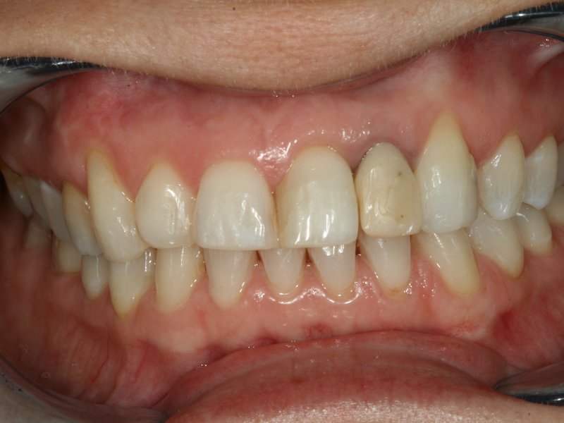 Výchozí stav – nevyhovující tvar, sklon a barva zubů a výsledek (vpravo)