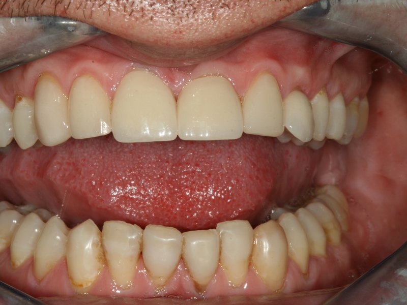 Komplexní estetická rekonstrukce pomocí celokeramických korunek v horní čelisti v kombinaci s bělením zubů před zhotovením korunek
