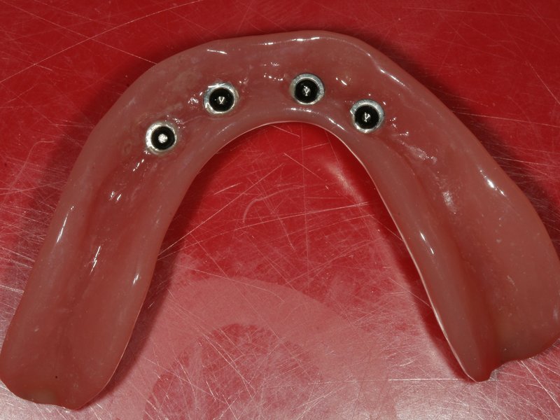 Celková hybridní náhrada s otvory pro upevnění v dutině ústní pomocí dentálních implantátů, které zajistí lepší stabilitu náhrady