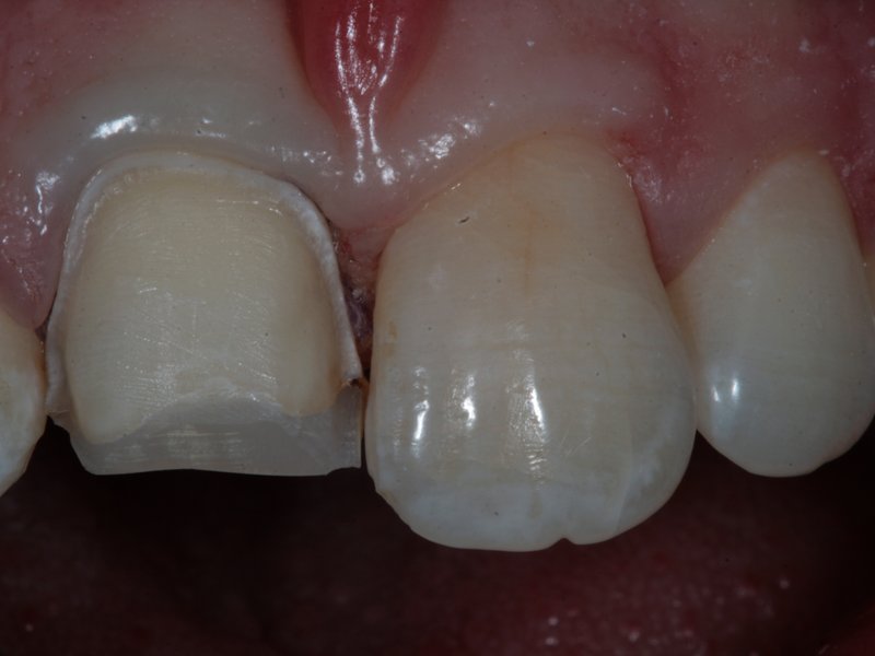 Zub napreparovaný na estetickou fasetu. Ve výsledku byl zachován přirozený vzhled.