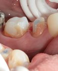 Zuby po preparaci na korunku připravené k otiskování a vpravo s nacementovanými korunkami