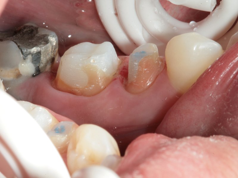Zuby po preparaci na korunku připravené k otiskování a vpravo s nacementovanými korunkami