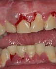 Masivní nánosy povlaku,zubního kamene a krvácení dásní, vpravo stav po dentální hygieně
