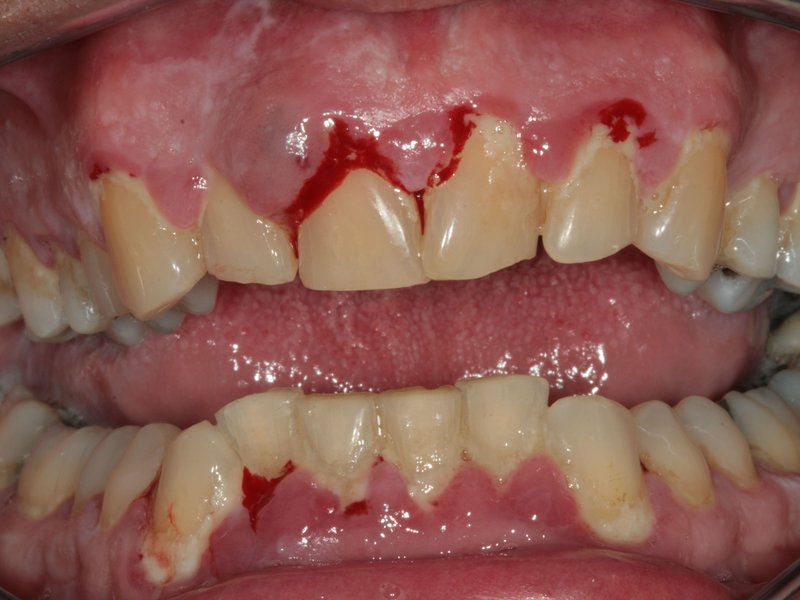 Masivní nánosy povlaku,zubního kamene a krvácení dásní, vpravo po profesionální dentální hygieně 