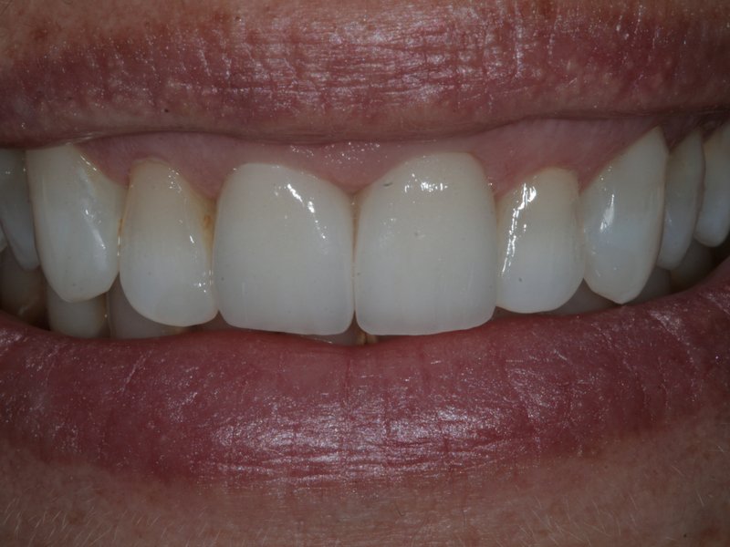 Zuby po úpravě pomocí estetických faset