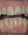 Odstín zubů před domácím bělením, vpravo po bělení