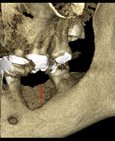 Augmentace – umělý kostní materiál v kostním defektu dolní čelisti