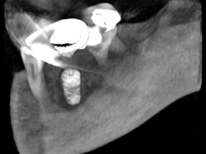 Zavedený dentální implantát na CT scanu