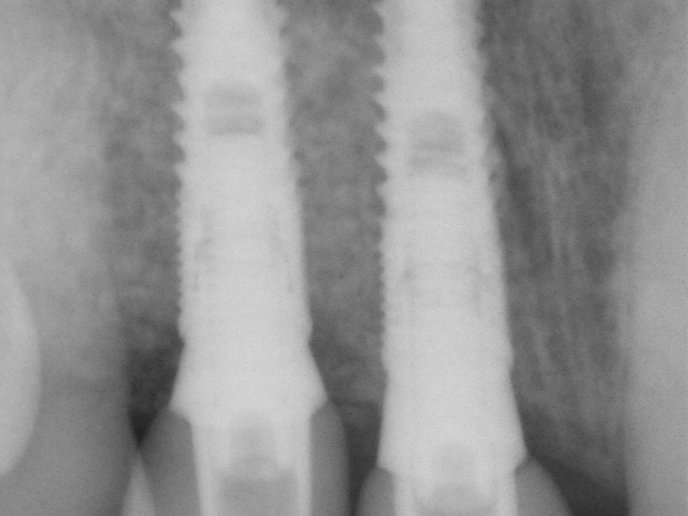 Dentální implantáty nahrazující chybějící řezáky
