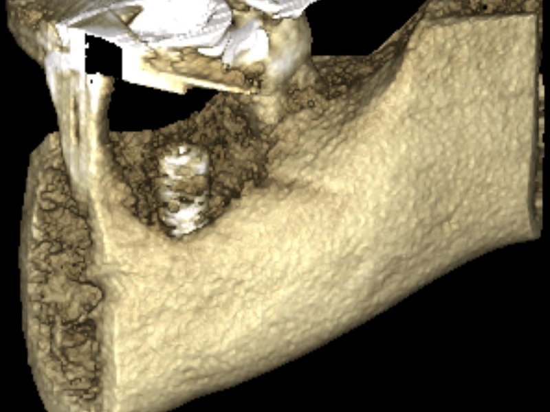 Zavedený dentální implantát na CT scanu