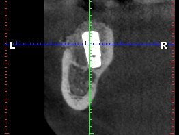 Implantát na CT scanu