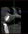 Zavedený implantát a doplnění kosti umělým kostním materiálem na CT scanu