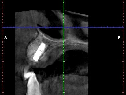 Zavedený implantát a doplnění kosti umělým kostním materiálem na CT scanu