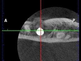 Implantát na CT scanu