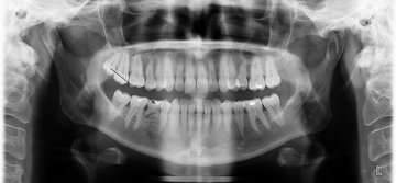 Autotransplantace zubu