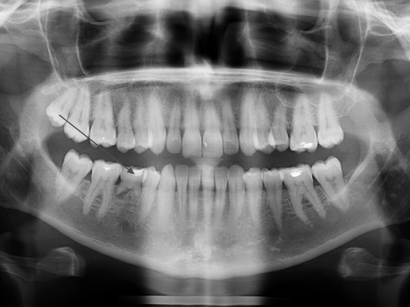 Transplantace horní stálé osmičky do místa dolní dočasné pětky z důvodu nezaložení zárodku pro stálou pětku