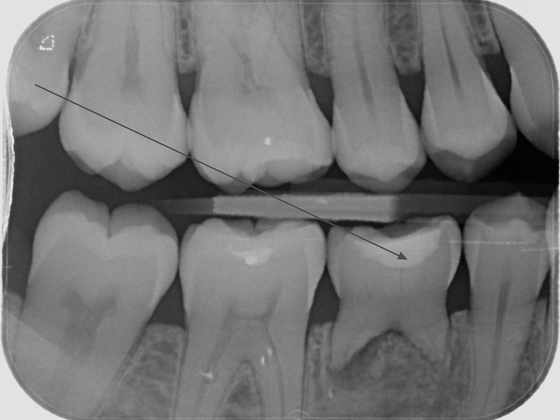 Dolní dočasná pětka se zánětem v okolí kořene – zub je vytrhnut