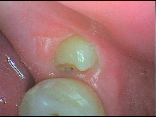 Částečně prořezaná dolní osmička, která má nepříznivou polohu a je bez šance na normální prořezání do dutiny ústní nahradila dolní šestku (vpravo)