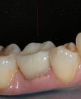 Dočasná pětka přetrvávající v dutině ústní z důvodu nezaložení stálé pětky