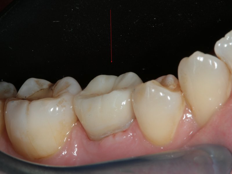Dočasná pětka přetrvávající v dutině ústní z důvodu nezaložení stálé pětky