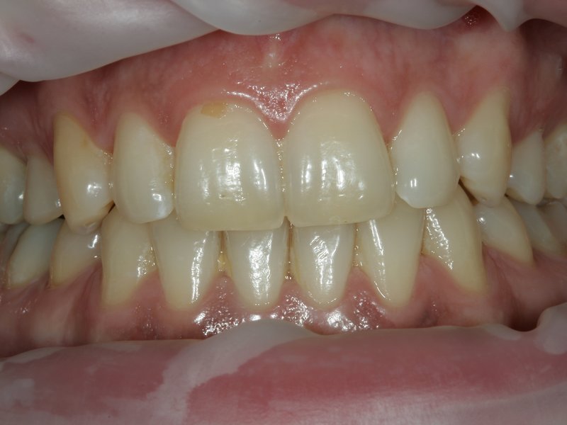 Odstín zubů před domácím bělením a vpravo výsledek po bělení