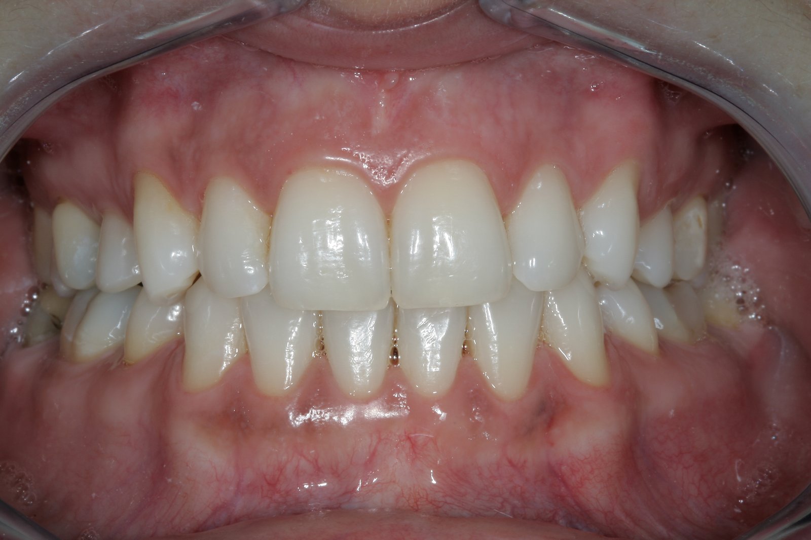 Co je dobré na bělení zubů?