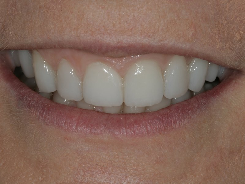 Zuby po úpravě pomocí estetických faset