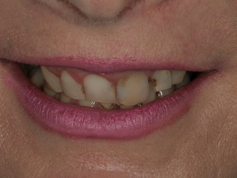 Výchozí stav – nevyhovující tvar, sklon a barva zubů (vlevo) a zuby po úpravě pomocív estetických faset (vpravo)