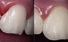 Ukázka nedokonale vyčištěného stálého zubu u 10-i letého dítěte.  Vpravo – zub se u dásně neleskne, je pokrytý povlakem a dáseň je zanícená.  Vlevo po vyčištění – zub se leskne v celé délce, je zbaven plaku.