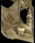 Zobrazení uložení dolní osmičky pomocí CT scanu